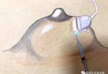 关于乳头疾病的十个常识-知道了吗?