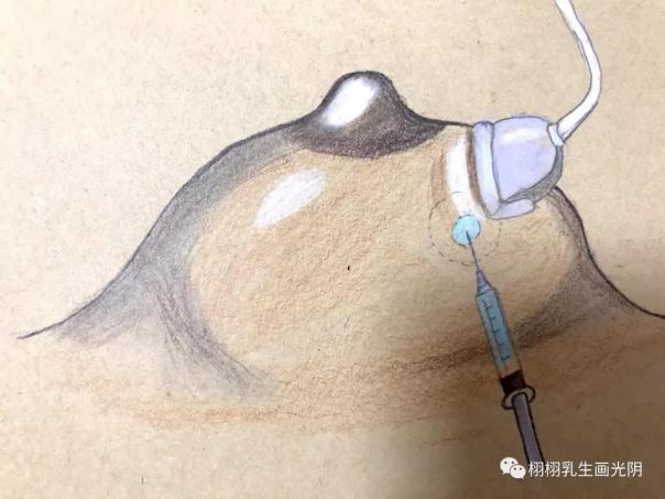 关于乳头疾病的十个常识