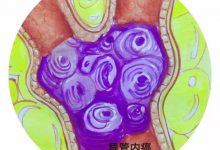 与死神赛跑，乳腺癌能活多久-知道了吗？